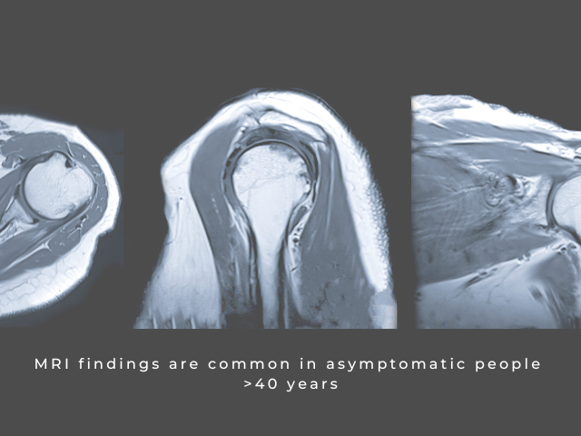 MRI Results: Are Abnormal Findings Really Abnormal?